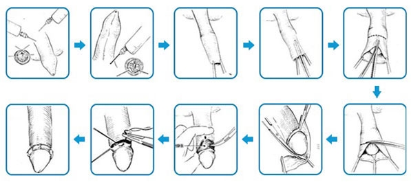 cắt bao quy đầu thẩm mỹ