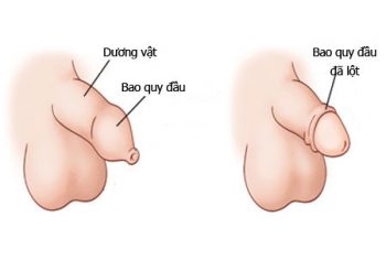 Bao Quy Đầu Là Gì ? Và Các Bệnh Về Bao Quy Đầu